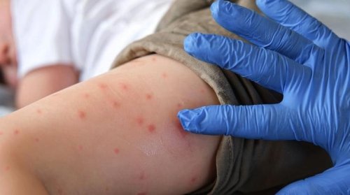 Регистриран е случай на морбили в Софийска област