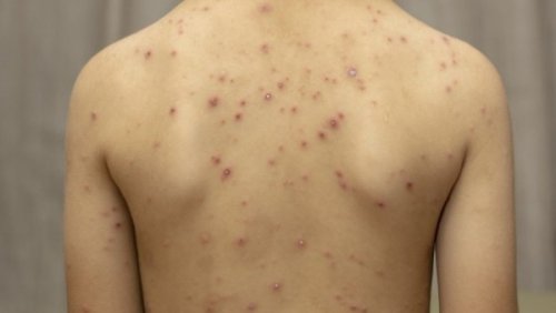 Морбили в Белослатинско: отделението прелива, огнището вече излиза извън общината